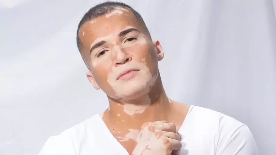Model With Vitiligo Says Strangers Avoided Him As They Thought It Was Contagious