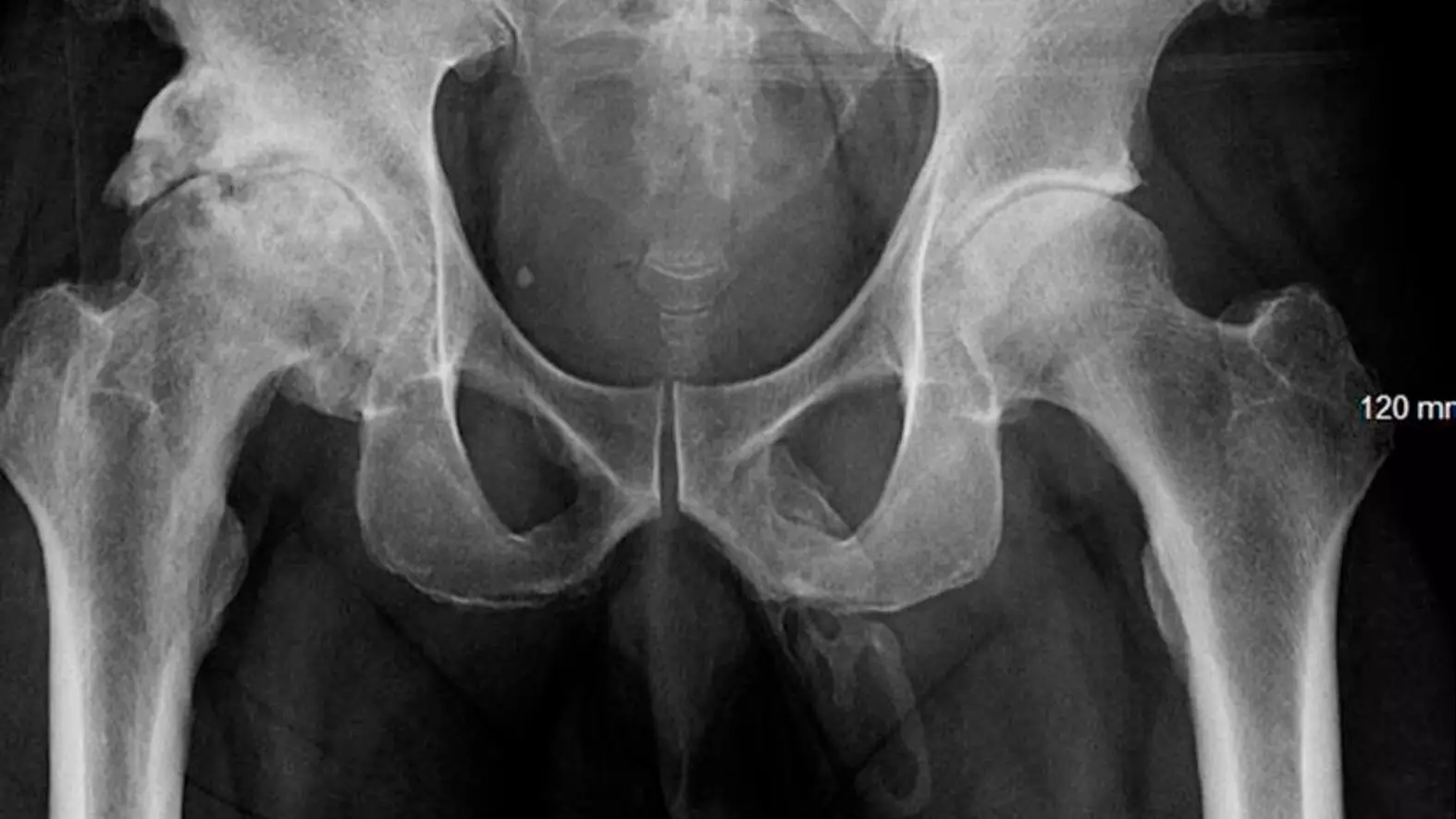Man Shocked To Find That His Penis Was Turning Into Bone