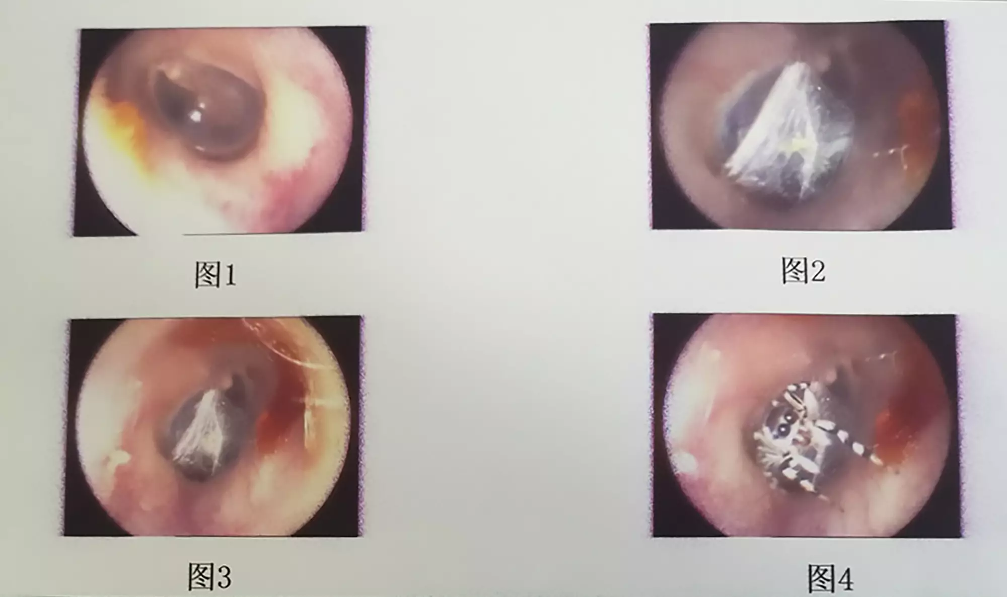 A spider and its web found inside the female patient's ear.