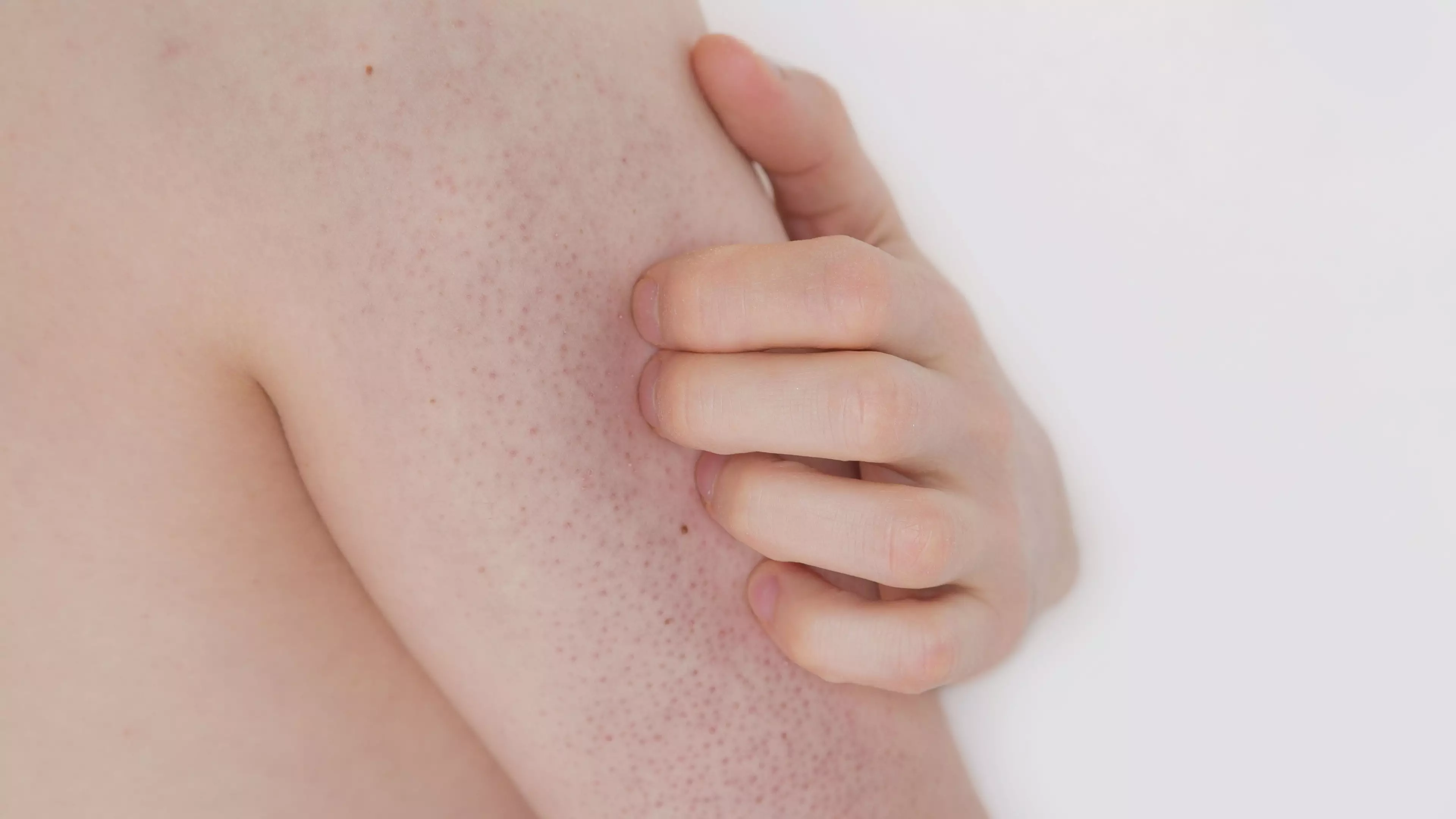 Here's How To Get Rid Of Chicken Skin AKA Those Annoying Bumps On The Back Of Your Arms