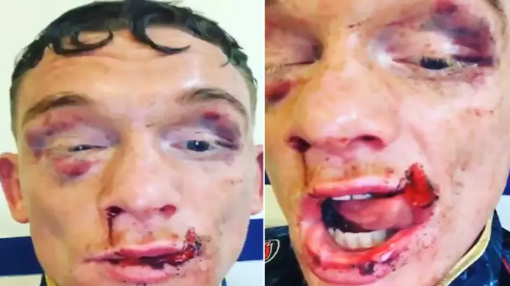Boxer's Lip Is Genuinely Hanging Off After Fight And It's Grim