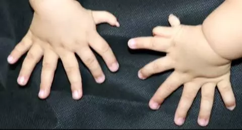 This Baby Boy Was Born With Far Too Many Fingers And Toes