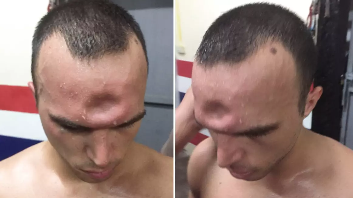 Muay Thai Boxer Suffers Horrific Injury After Brutal Elbow To The Skull