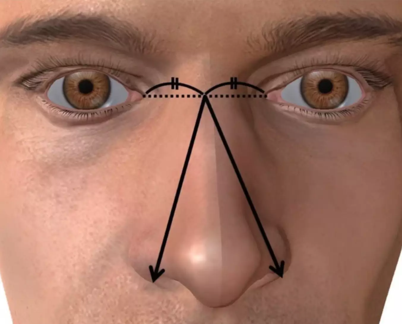 Nose size was defined as the longer distance between the midpoint of the left and right medial ocular angles and the outside of the left or right nose wings.