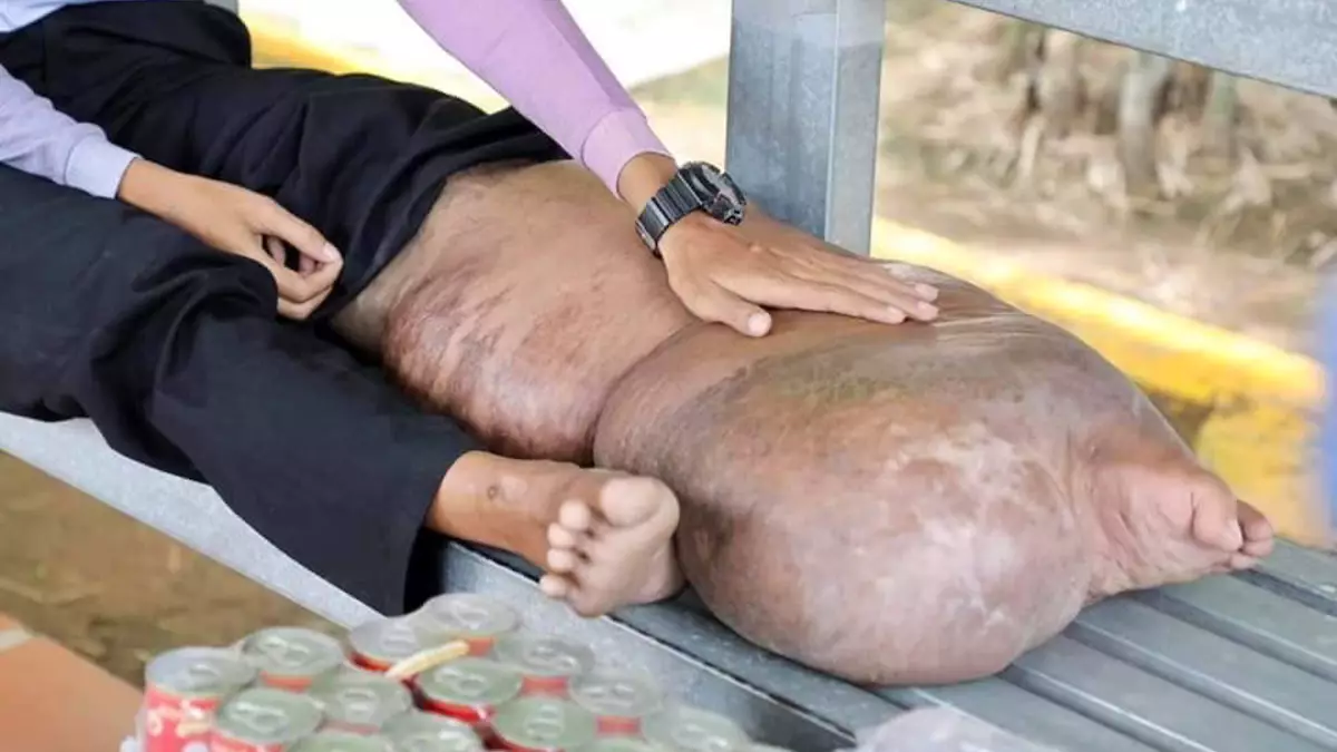 Man's Leg Swelled To Size Of Pig After Getting Bitten By Mosquito