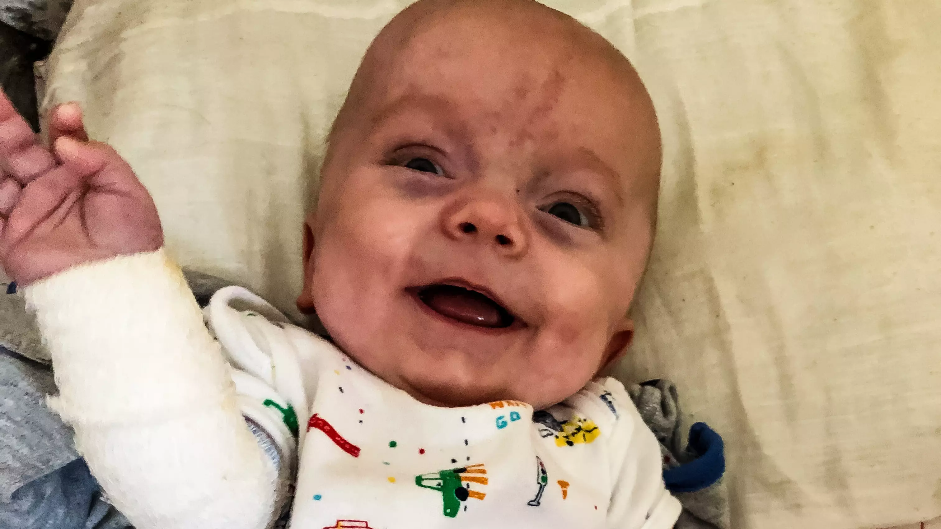 Premature Baby Born With No Skin Defies All Survival Odds 