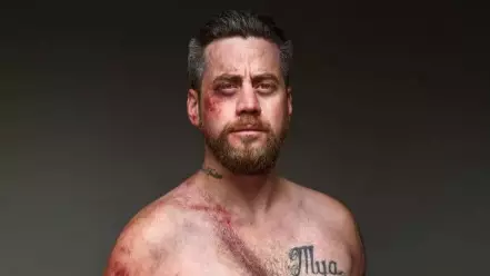 Car Crash Survivors’ Injuries Recreated In Chilling Photoshoot