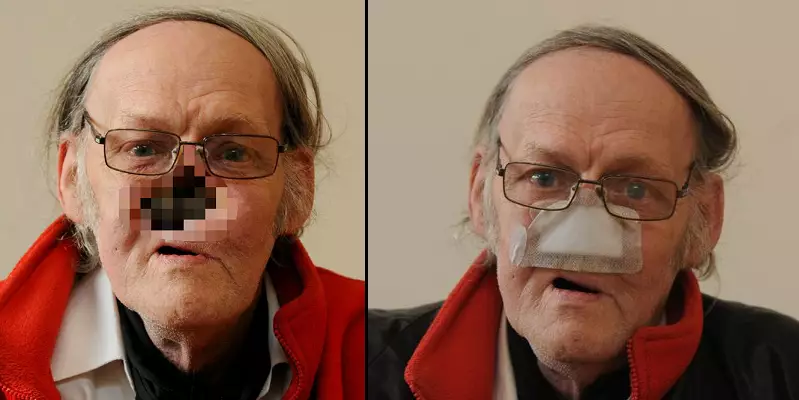 Man Left With Hole In His Face Speaks About What Life Is Like