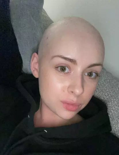 Sophie shaved her head when her hairloss reached 90% (
