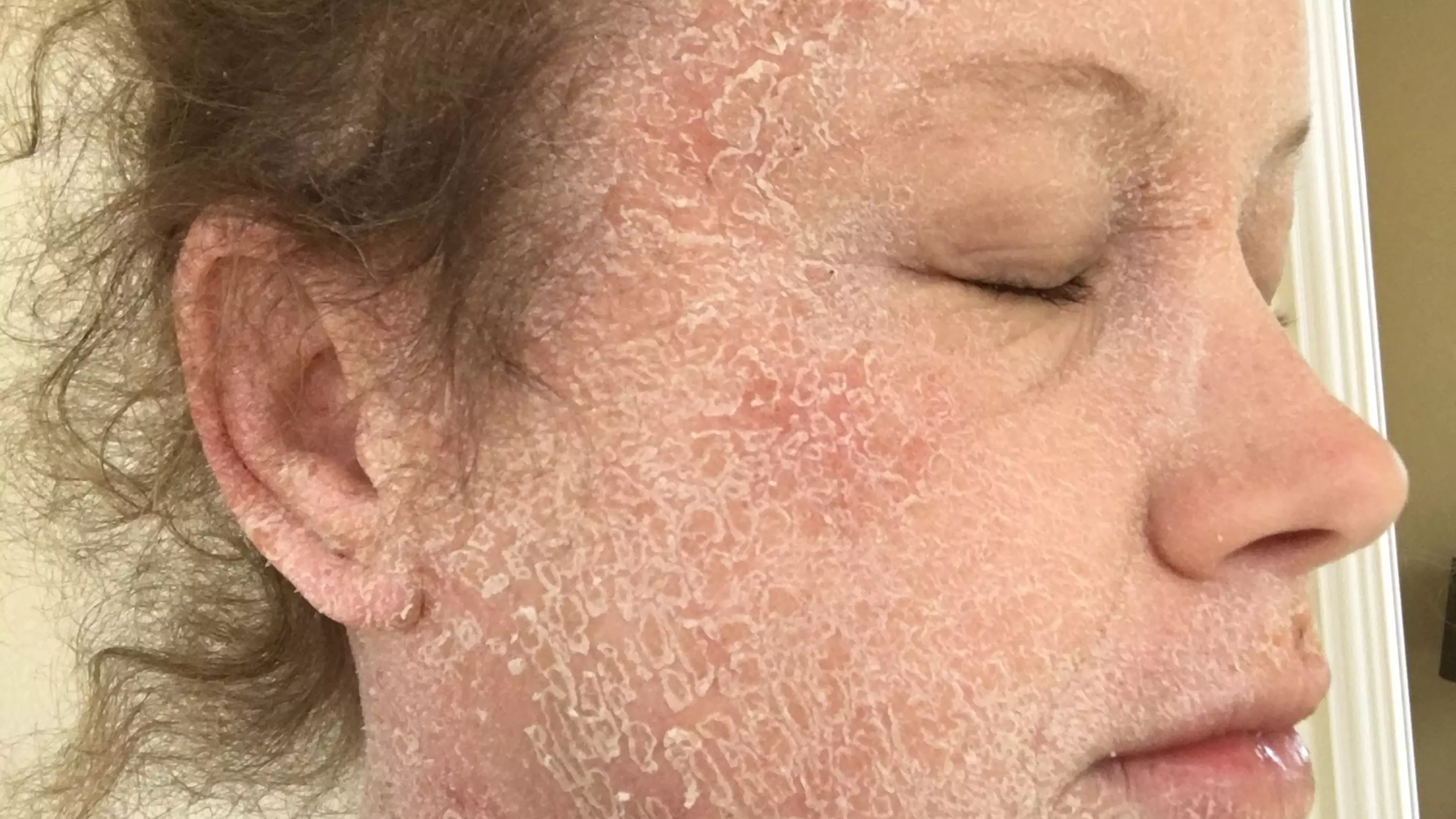 Woman Clears Up Her Severe Eczema By Drastically Changing Her Diet