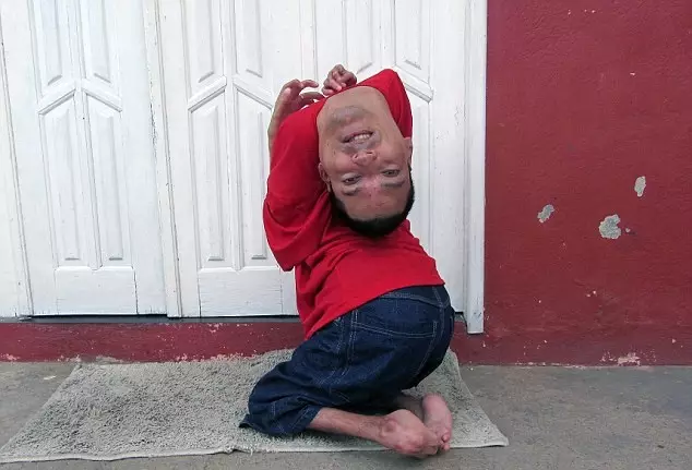 The Incredibly Inspiring Story Of The Man With The Upside-Down Head