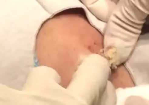 Surgeon Removes Giant Cheesy Cyst From Woman's Back