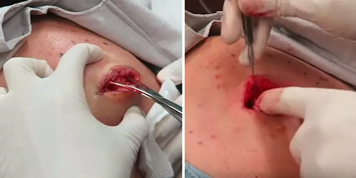 Dr Pimple Popper's Latest Video Is One Of Her Most Disgusting Yet