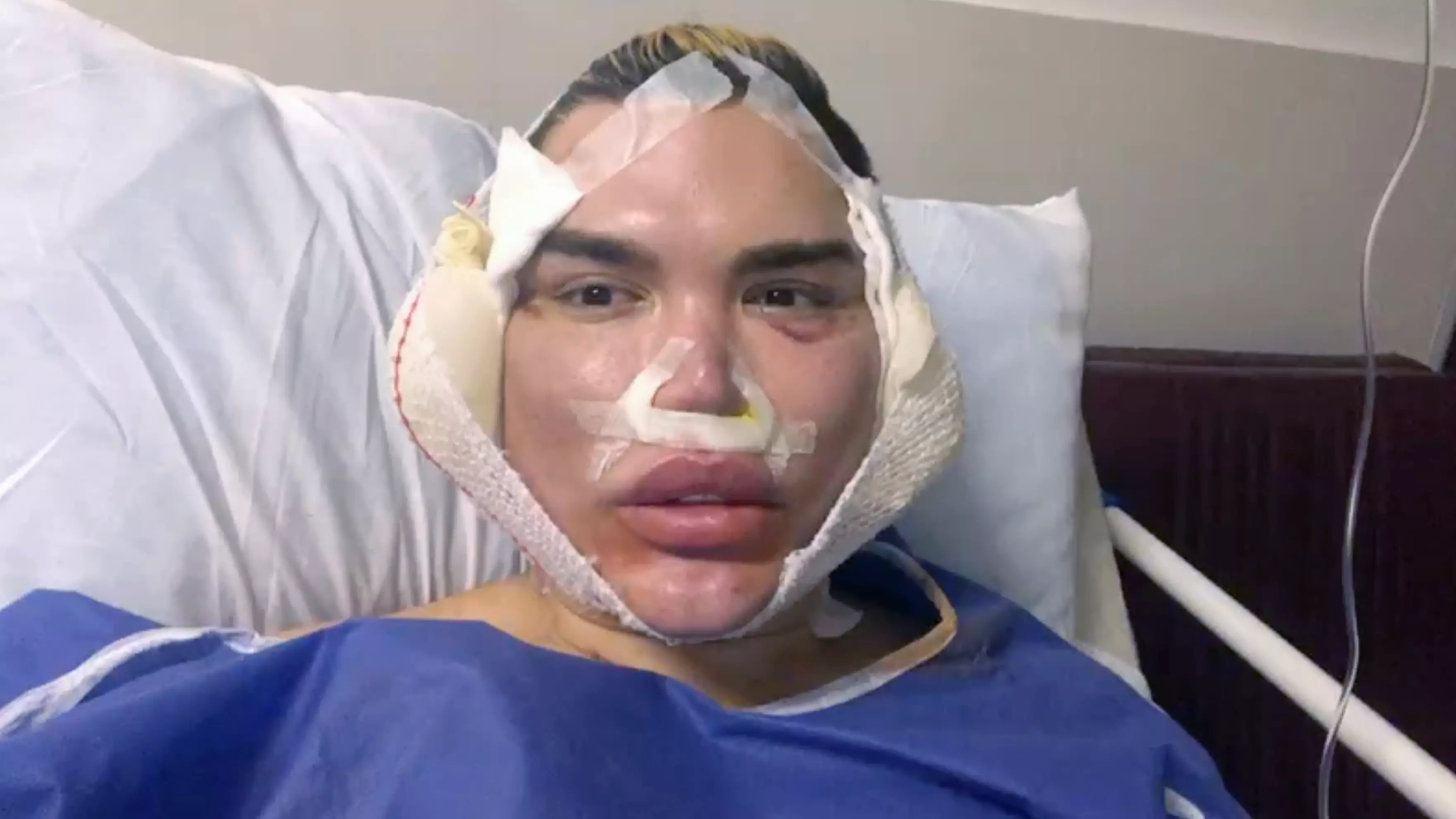 'Human Ken Doll' Rodrigo Alves Warns People About Facial Procedures After Revision Surgeries