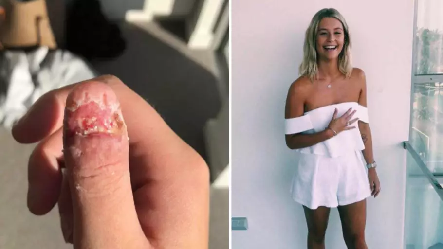Woman Has Thumb Amputated After 'Nail Biting' Causes Rare Form Of Cancer