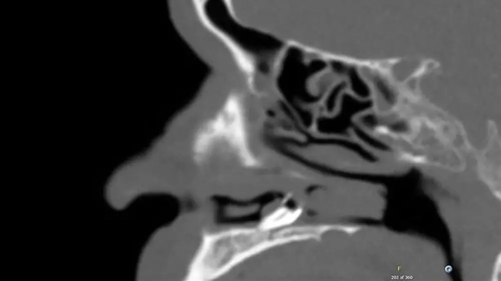 Man Finds Blocked Nose Was Caused By Tooth Growing In Nostril For Two Years