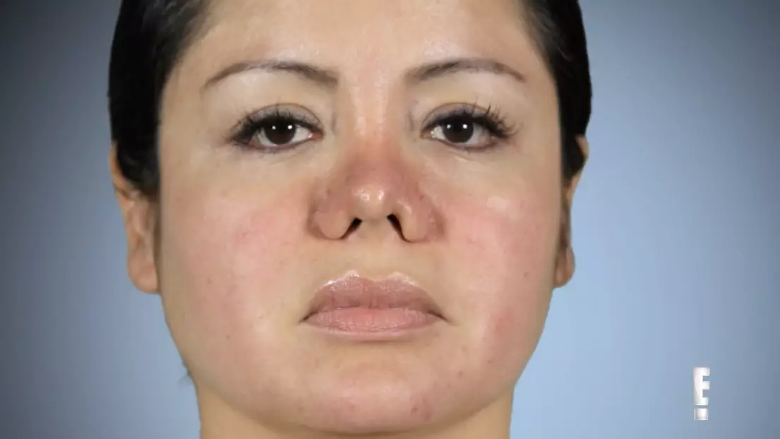 ​Woman Goes For Lipo But Wakes Up To Find She's Been Given A Nose Job