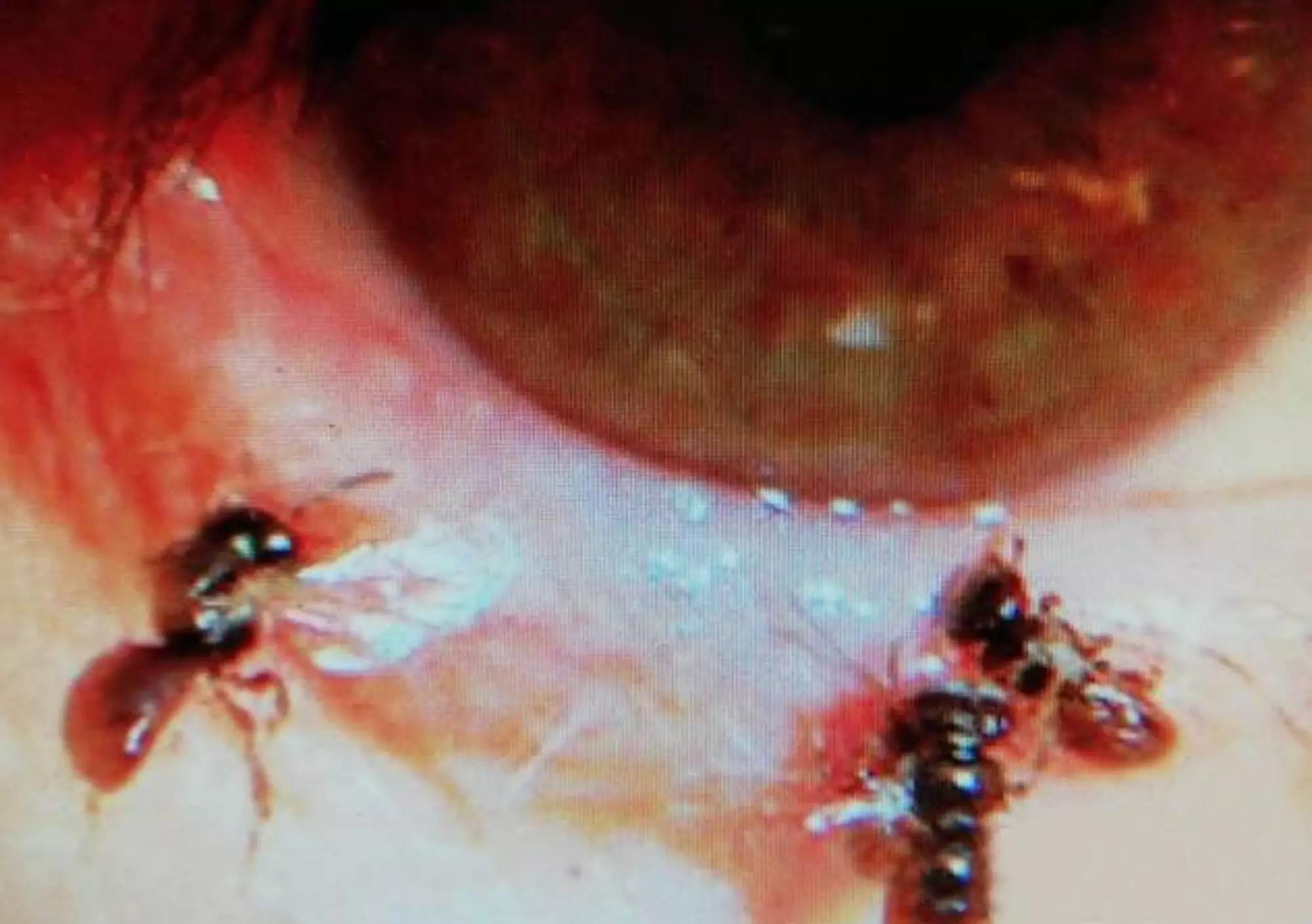 The doctor pulled four bees out of the woman's eye.