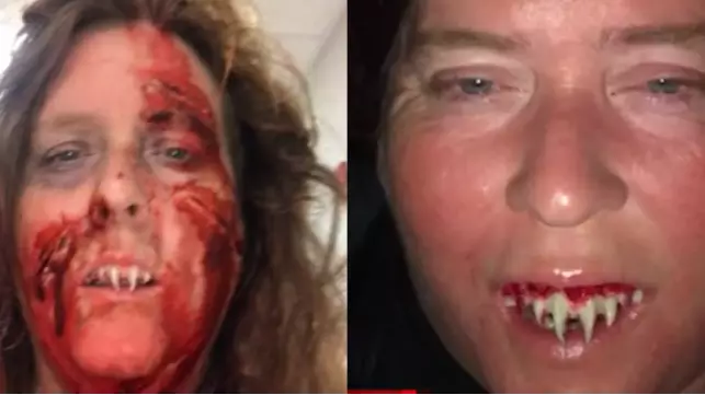 Woman Has To Make Trip To A&E After Plastic Fangs Become Stuck 