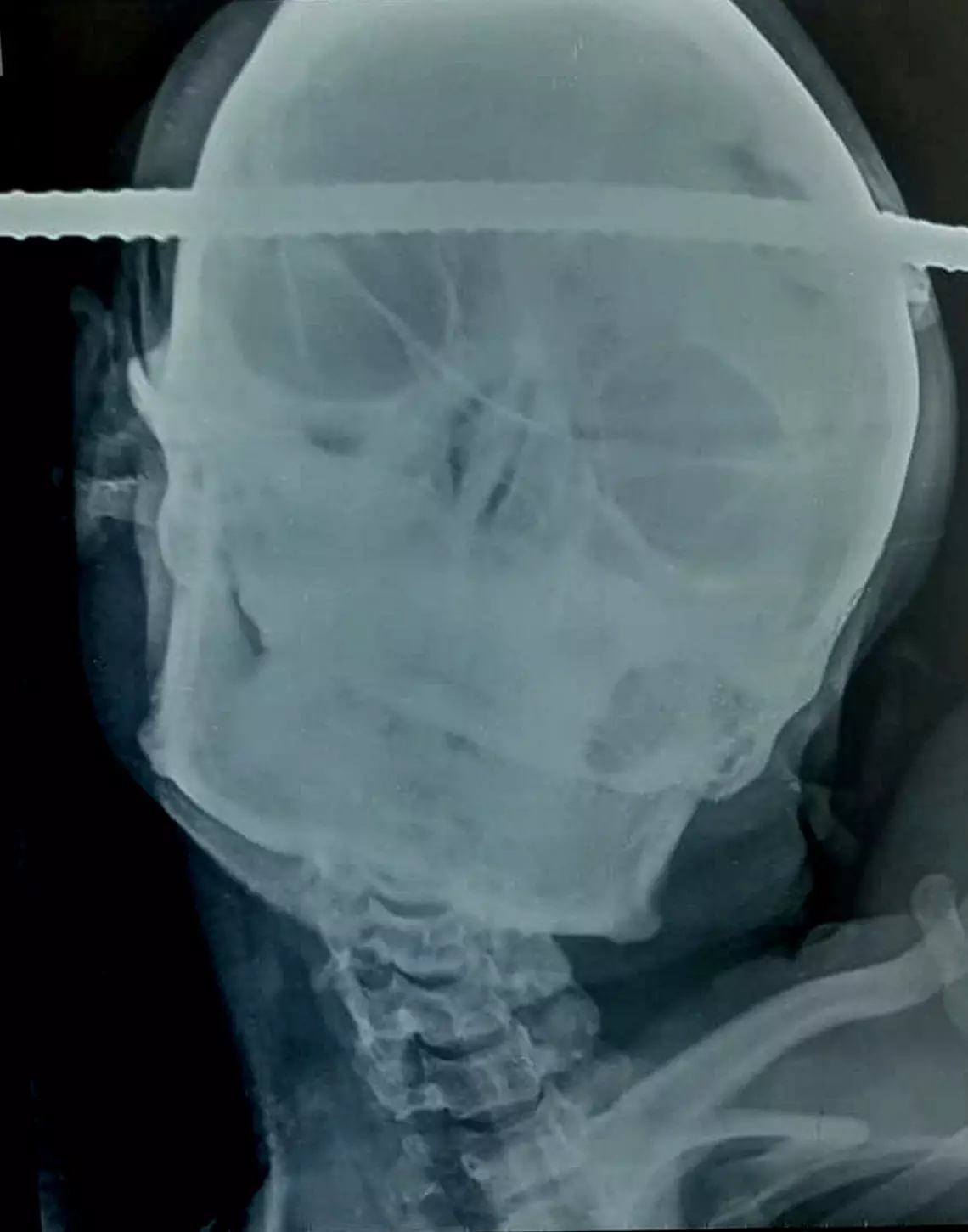 X-rays show the rod went straight through his head.