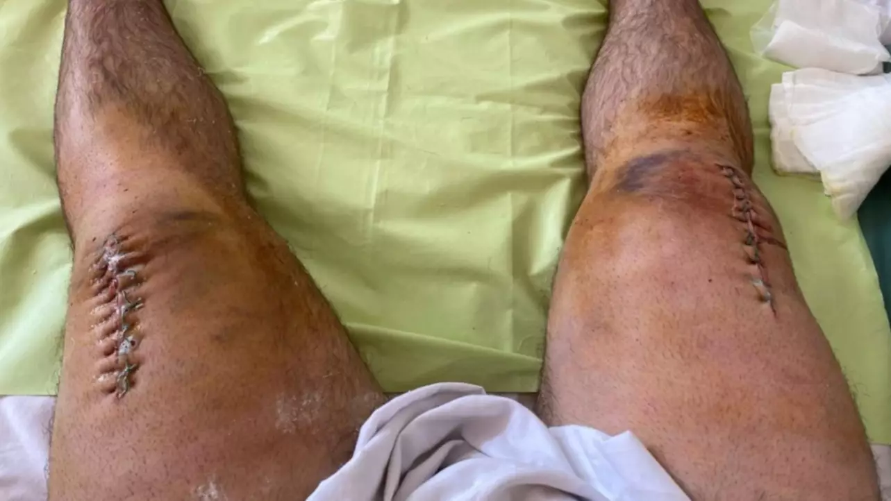 Viral Russian Powerlifter Who Fractured Both His Knees Reveals Massive Scars