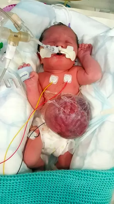 Little Laurel was in hospital for three and a half months (