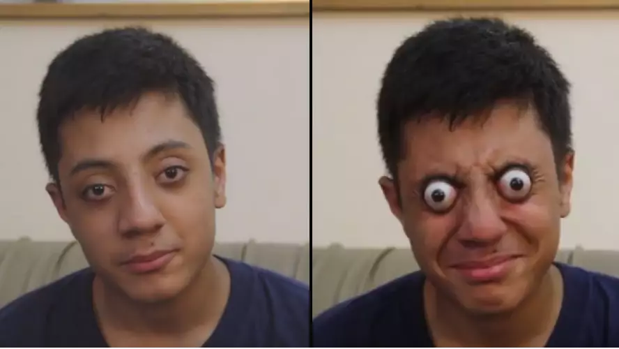 Teen Can Bizarrely Pop His Eyes Out Of His Head For One Minute