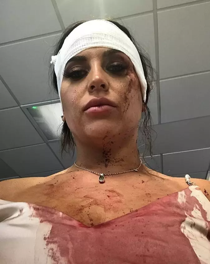 Samia Smith won't be able to work while her wounds heal.