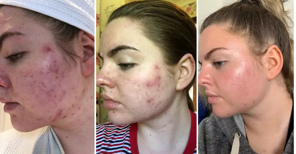 Vanessa says the product is responsible for her acne reduction (