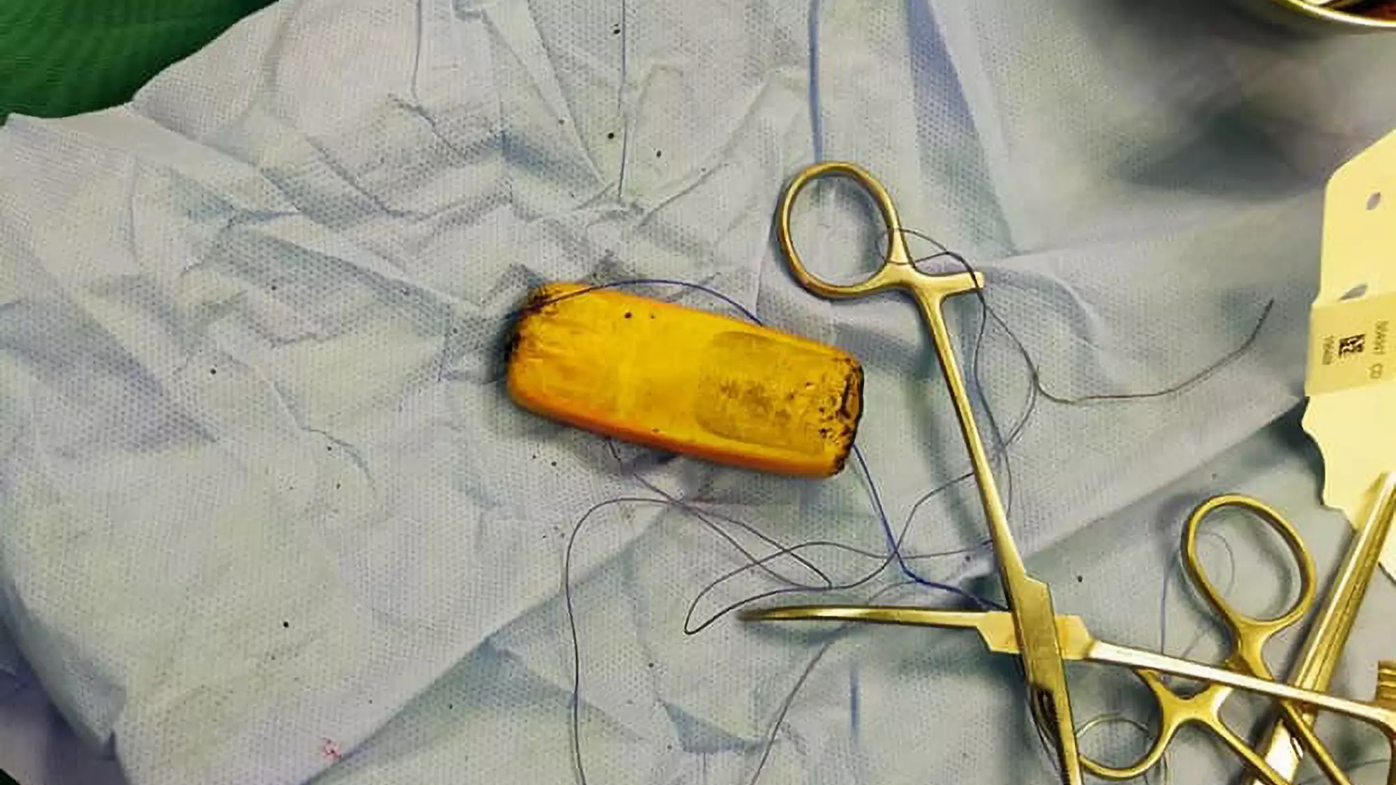 Man Lived With Phone In His Stomach For Half A Year