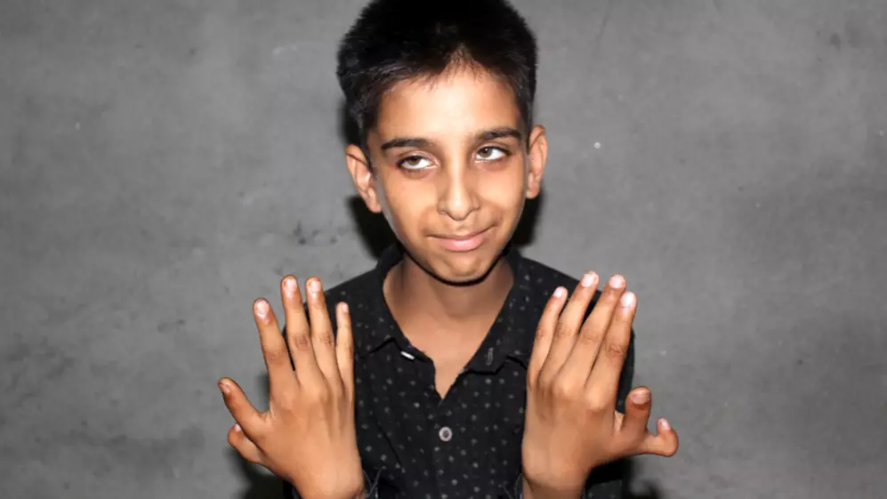 Twelve-Year-Old Boy Has An Extra Thumb On Both Of His Hands