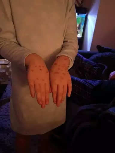 Lily covered in red permanent marker 'chicken pox'.