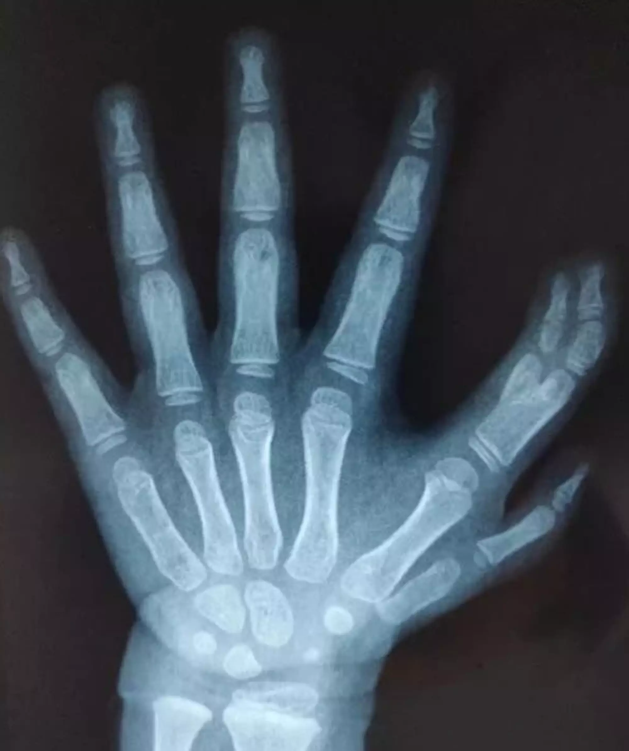 Doctors expect the girl's fingers to develop normally.