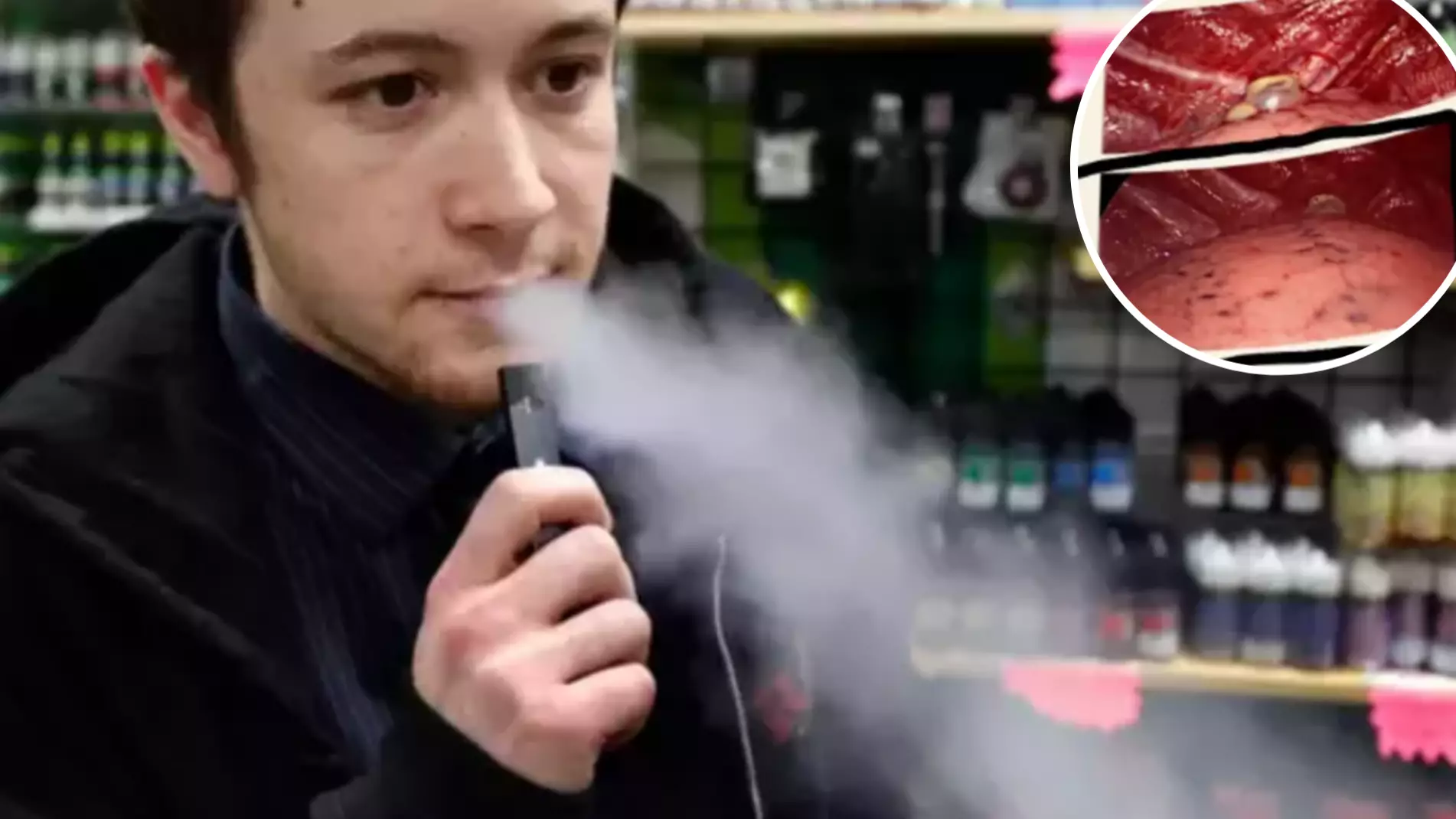 Doctors Shocked At Number Of Teens With Severe Lung Damage After Vaping