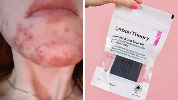 Woman Praises £6 Carbon Theory Soap For 'Curing Acne' In Days