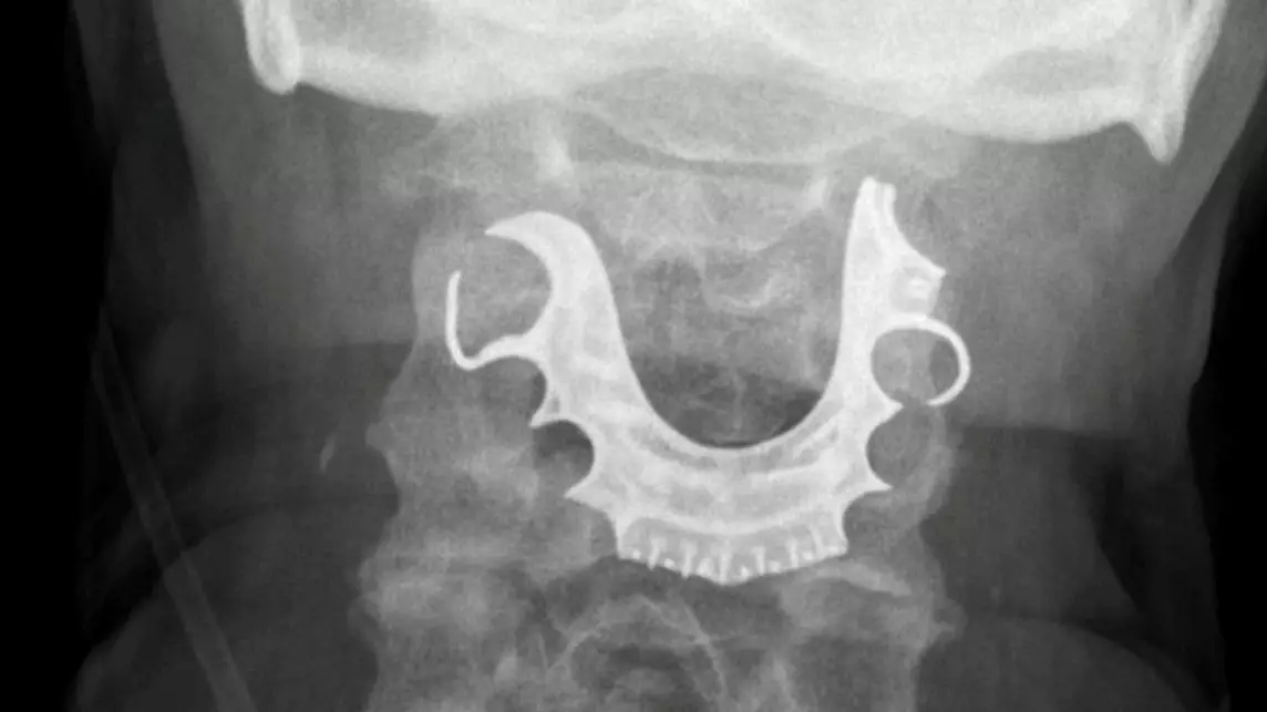X-Ray Shows OAP's Dentures Stuck In Throat For Eight Days After Operation
