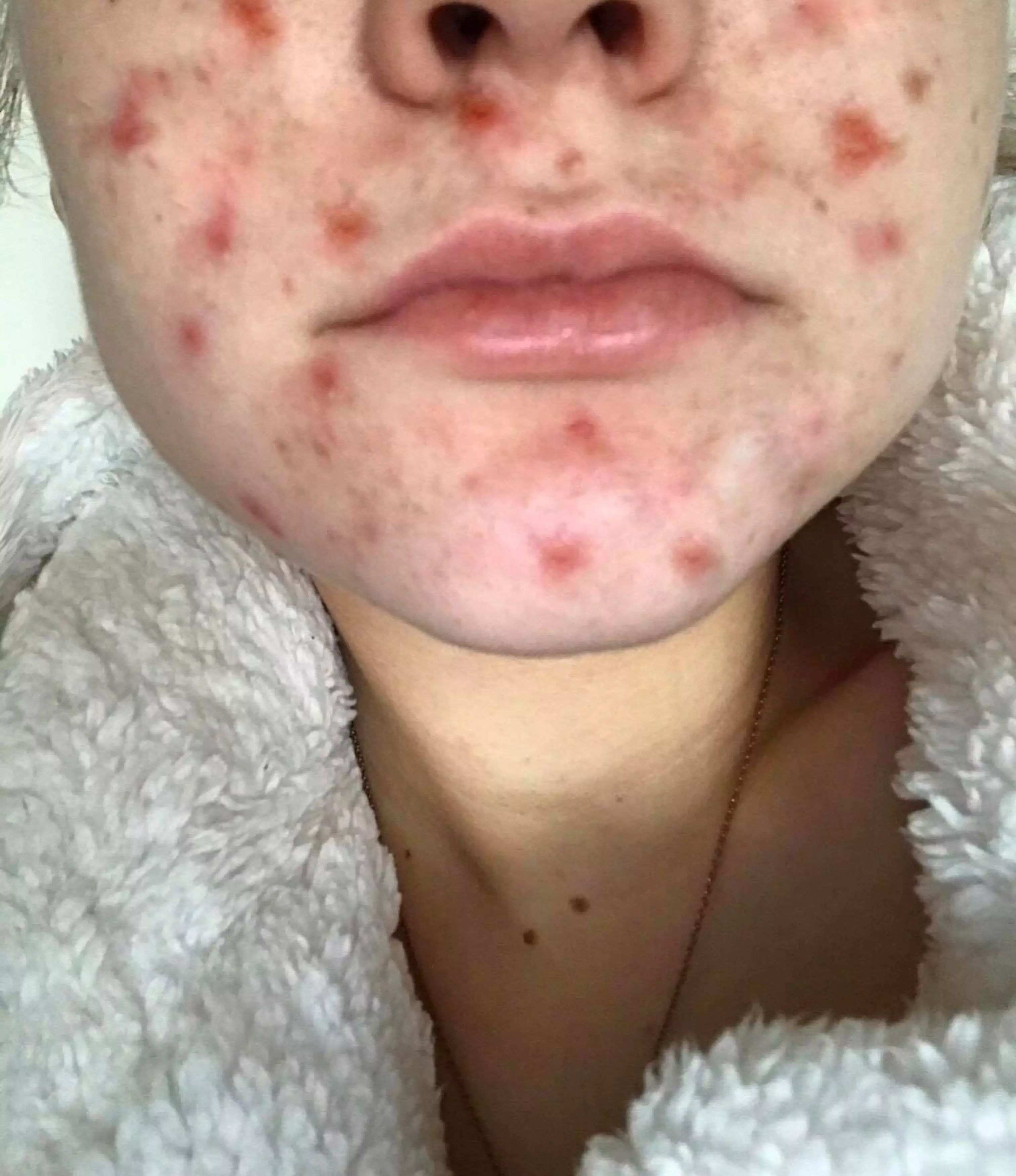 Ellie used to suffer with large, red spots all over her face (
