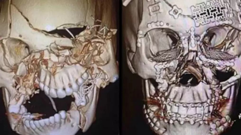 Doctor Shows Off Incredible Facial Reconstruction After Accident 