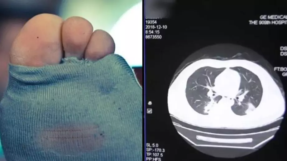 Man Gets Lung Infection From Sniffing His Own Smelly Socks
