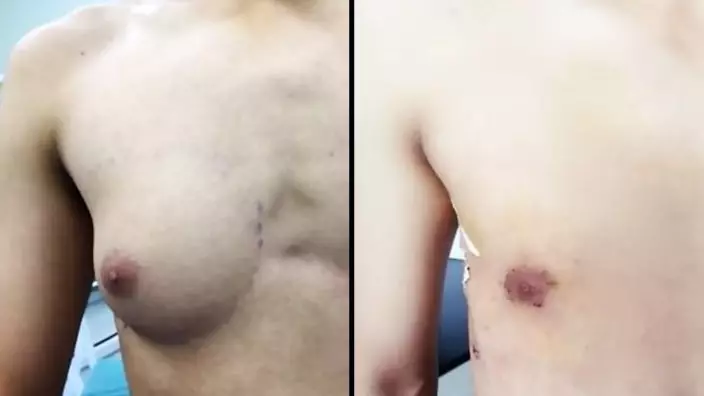 Teenage Boy Undergoes Surgery To Get Rid Of A-Cup Breast 