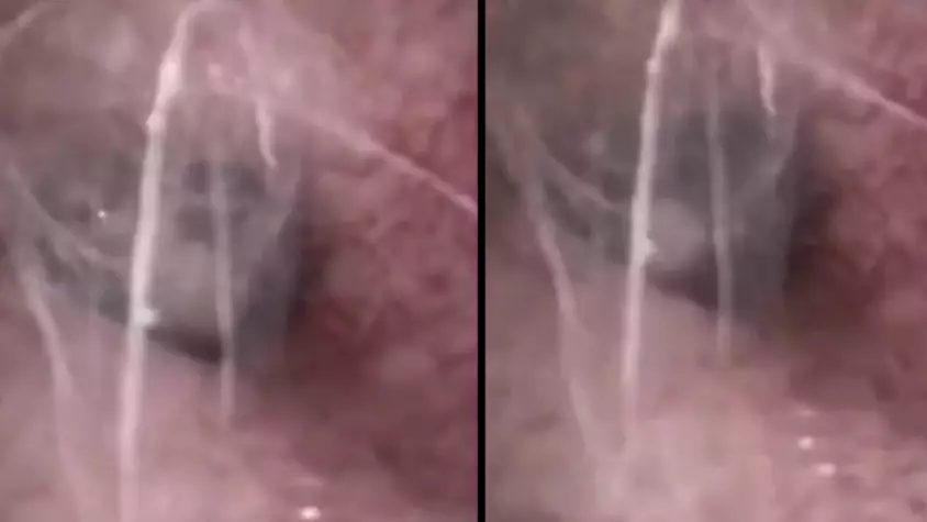 Doctor Finds Spider Spinning Webs Inside Pensioner's Ear