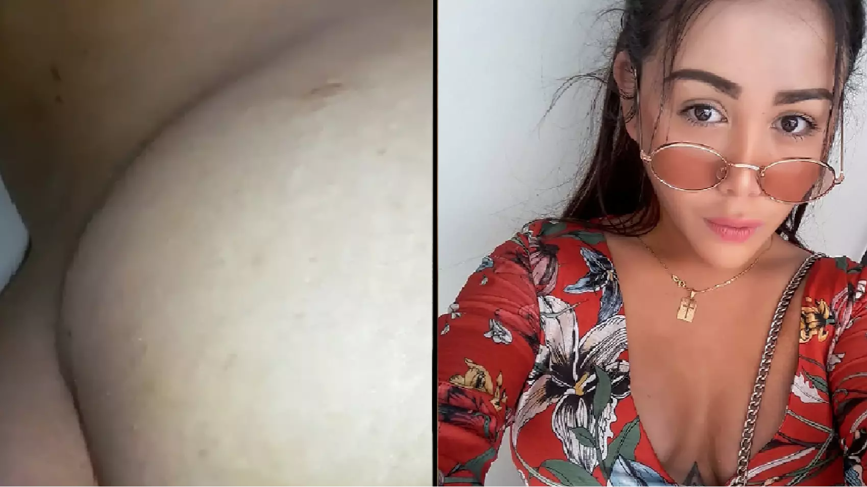 Woman Warns Against Butt Enhancement After Procedure Backfires... After Three Years 
