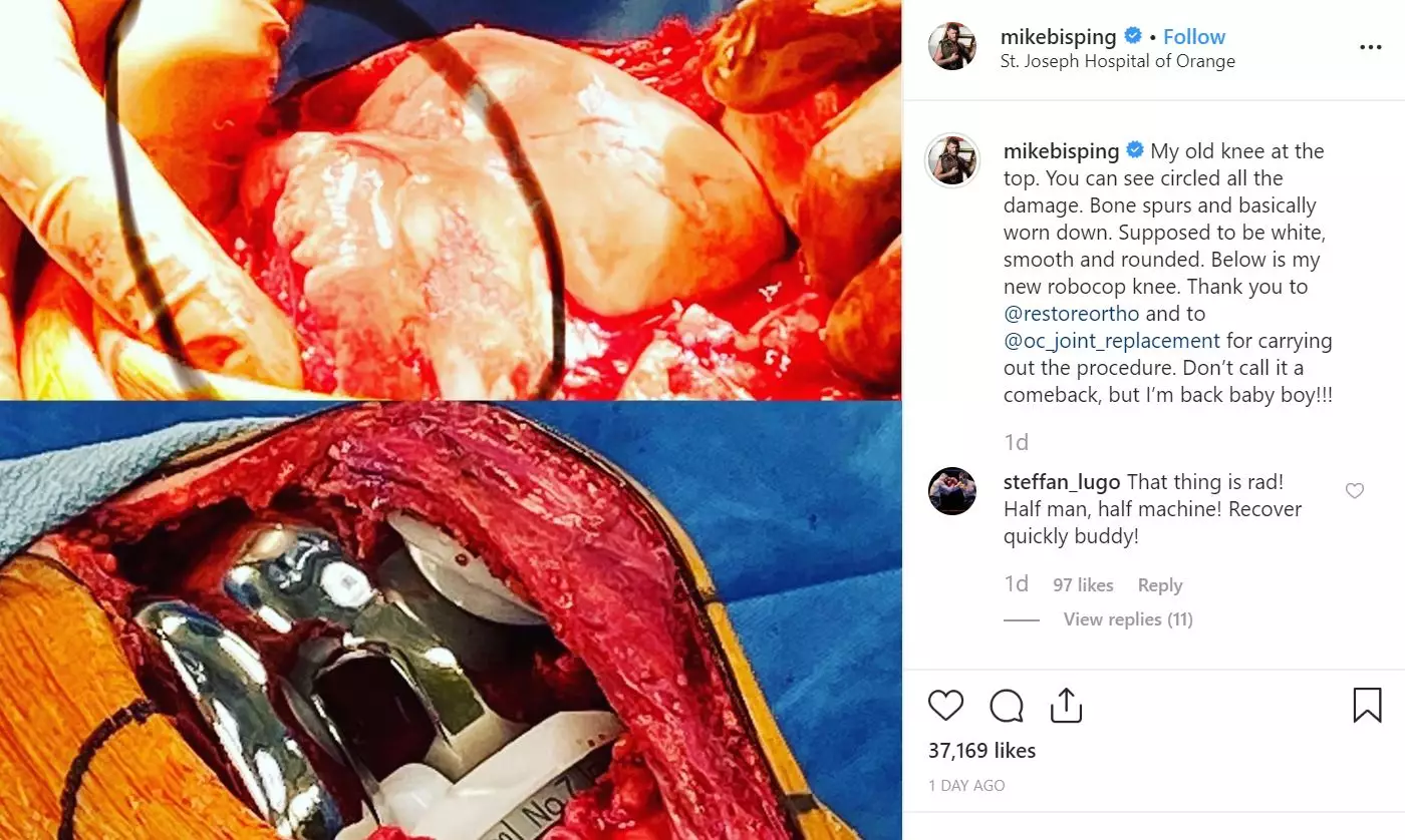 Michael Bisping shared images inside his knee on Instagram