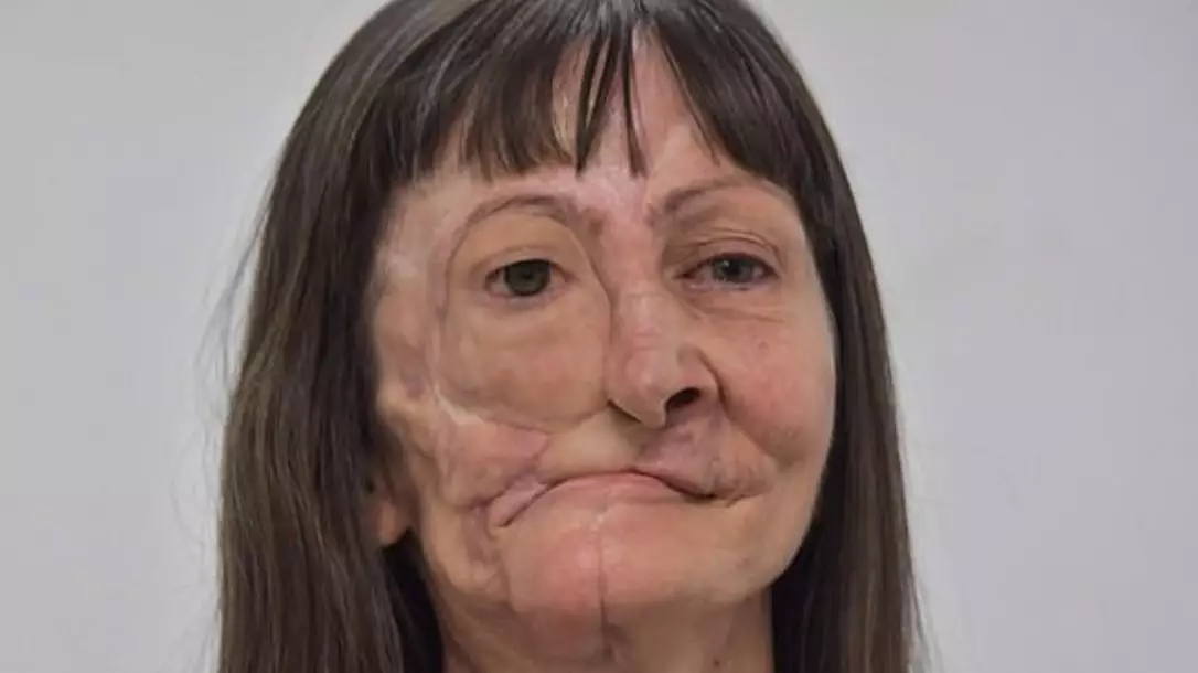 Skin Cancer Sufferer's Life Changed After 'Missing Piece' Of Her Face Replaced With Prosphetic