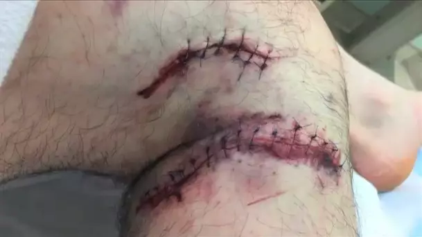 Wounds after grizzly bear attack