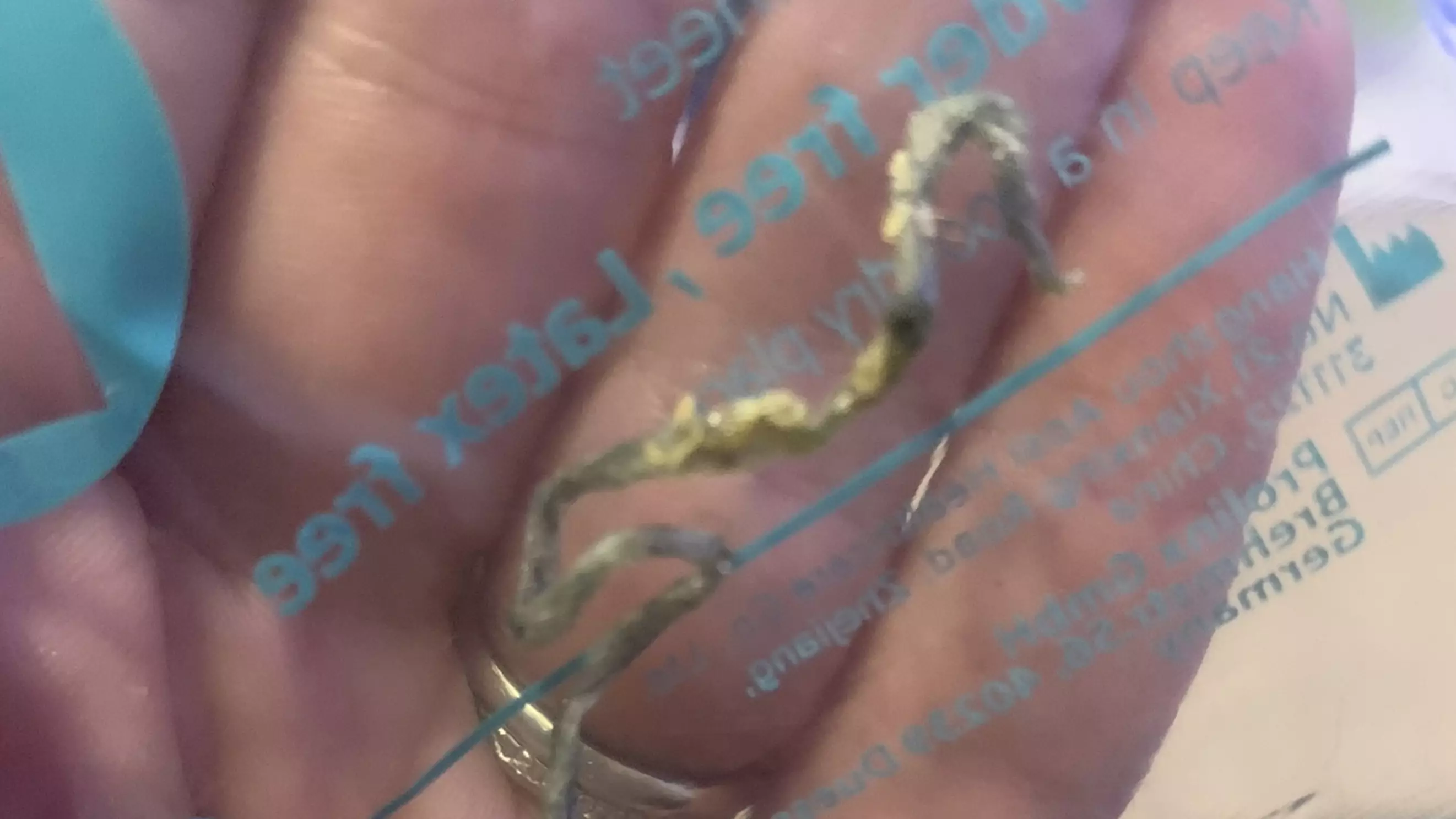 Mum Rushes Son To Doctors After Pulling Out 'Brain-Worm' Only To Discover It Was Tape