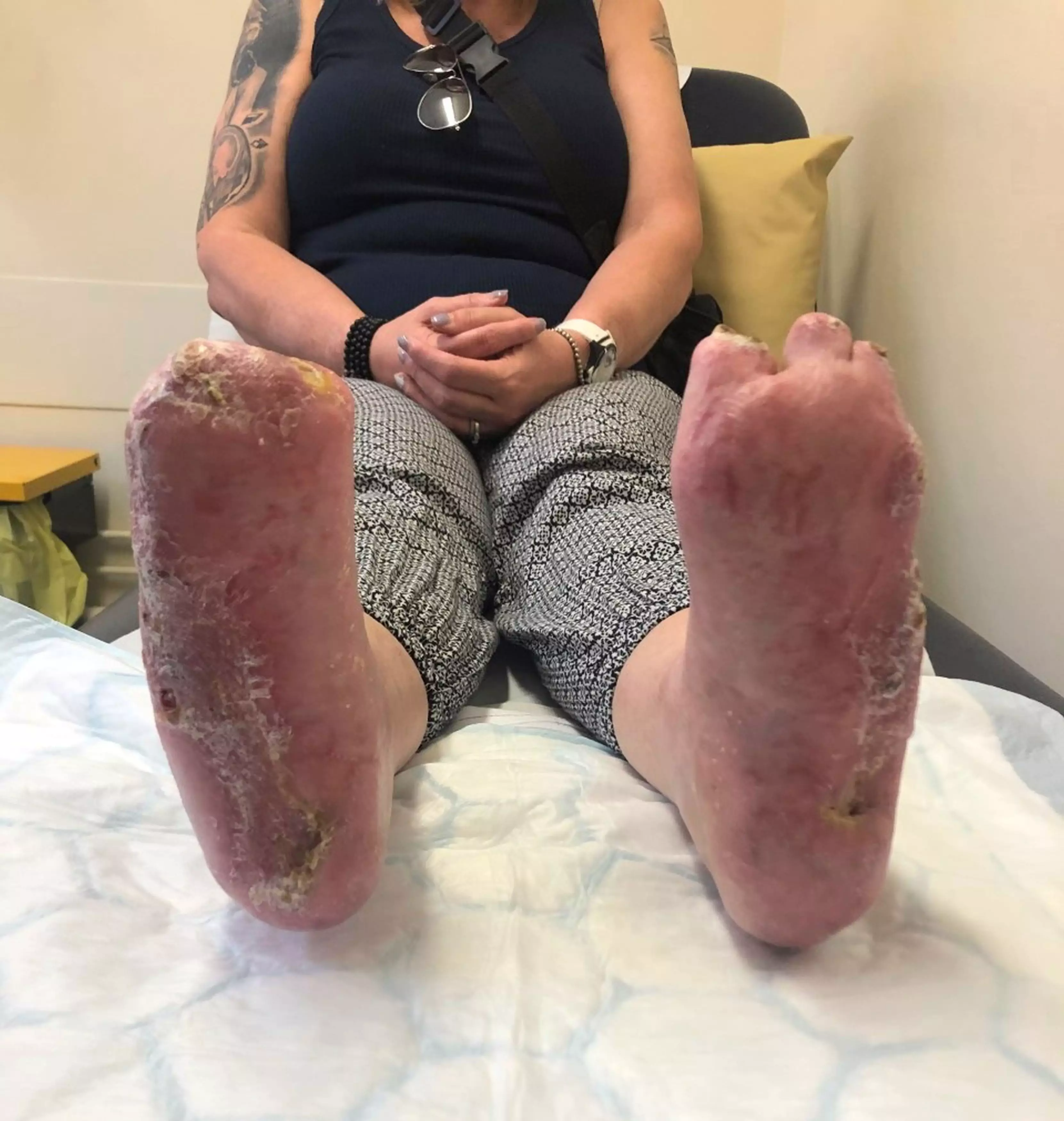 Ruth had to have her toes amputated after gangrene set in.