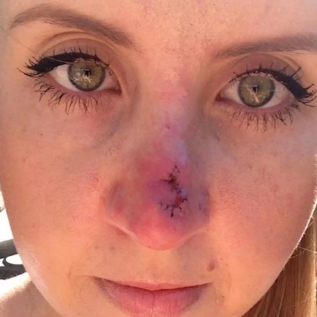 Lauren had Mohs surgery after doctors discovered the cancer had spread deep into her nose (