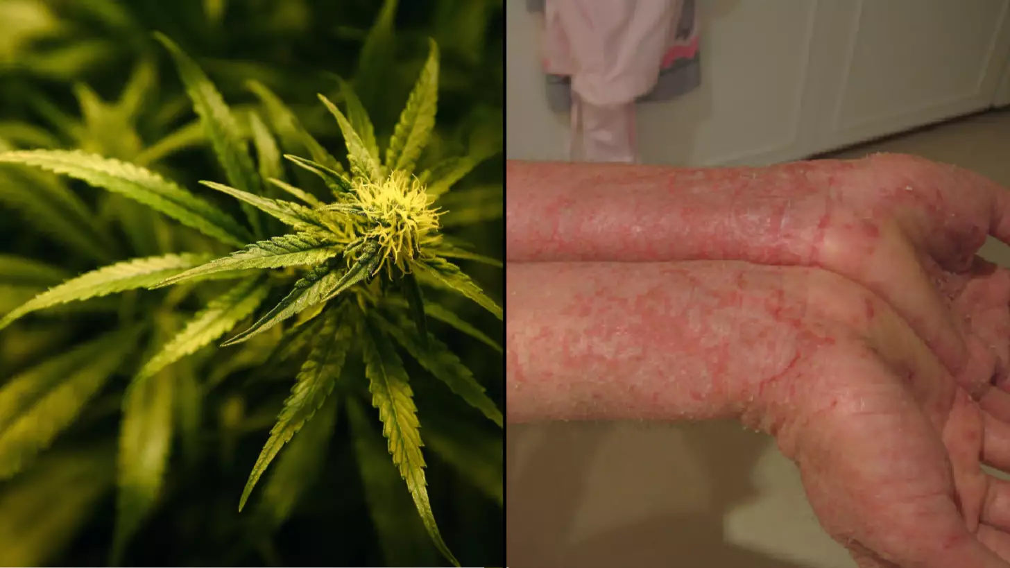 Marijuana Could Be The Solution To Your Eczema Problems