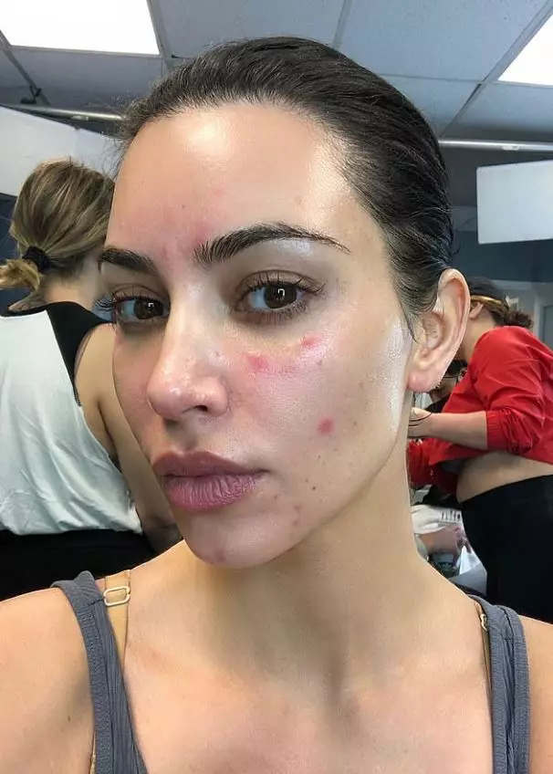 Kim Kardashian suffers from the skin condition (